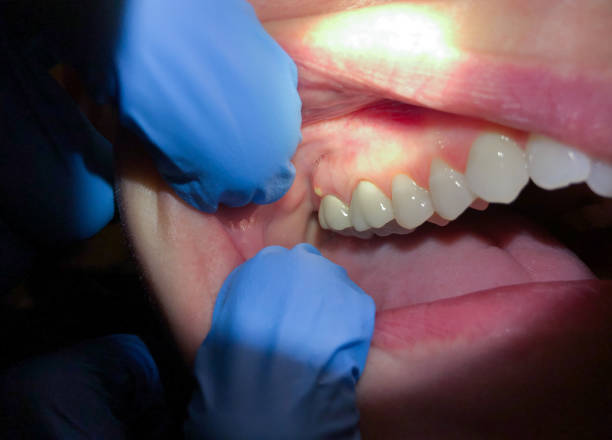 Best Emergency Dental Extractions in Byram, MS